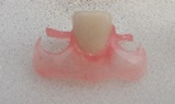 牙科树脂隐形义齿(小托)单颗假牙义齿加工假牙 活动牙 进口牙齿