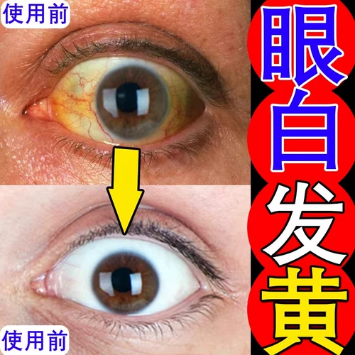 Глаза белые волосы желтые ясные и желтые, желтые, глазные яблоки, желтые глаза, белые глаза, белые глаза, капли глаз макулярного света, капли глазных капель