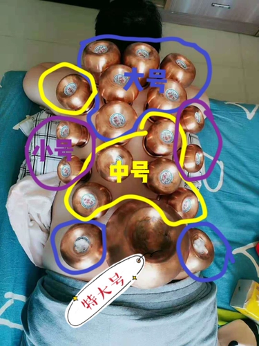 19 Вогнутые дновые комбинации медного огня могут убрать китайскую медицину, чтобы убрать сырость и стимулировать банки с холодным здоровьем, нагревание, полную обратную связь, объем, прижигание, прижигание