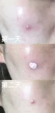 Lingqi Clearance разрешил Kate Somerville Kate Somerville Acne Water KS Small Powder Bottle Essence для удаления прыщей